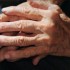 Hand surgery helpful for RA associated deformities