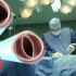 Simplified approach effective in aortic valve replacement