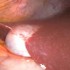 Morbidity high after percutaneous cholecystostomy for acute cholecystitis