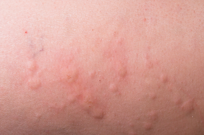 urticaria pictures #10