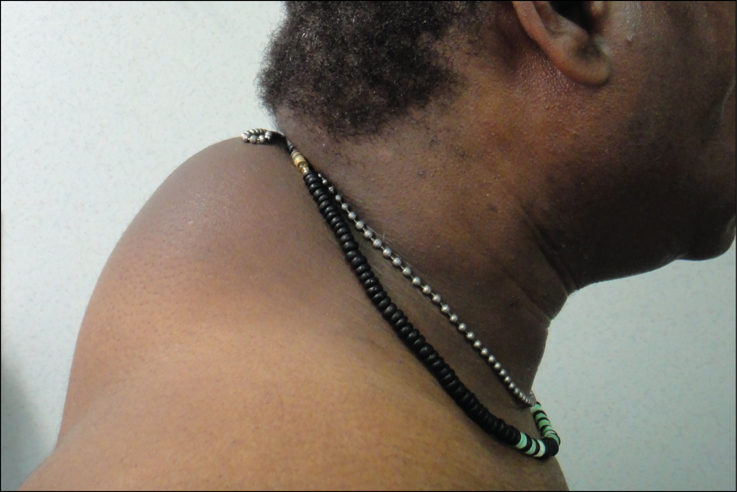 Cervical cancer scientific signs and symptoms