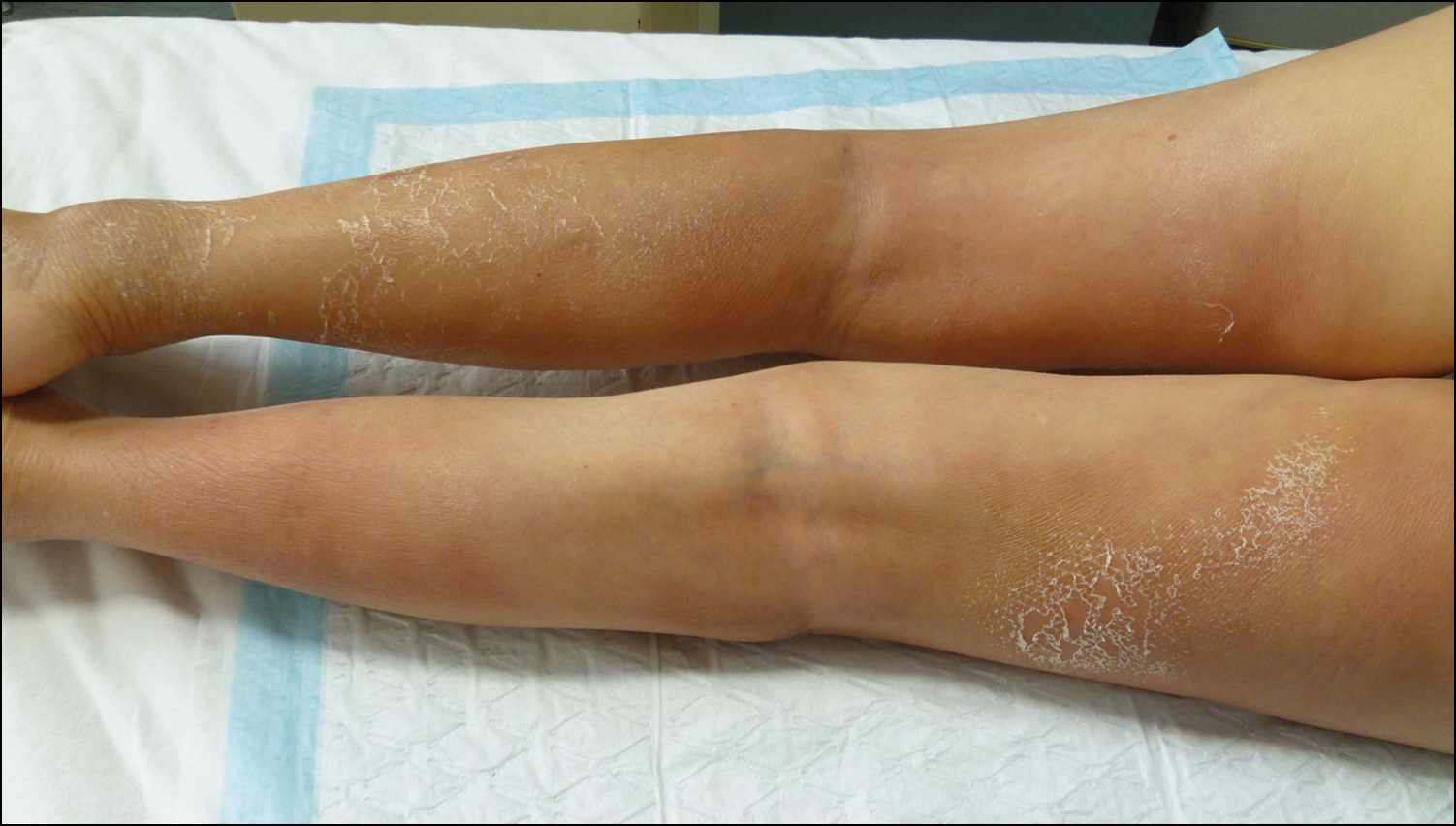 What S Your Diagnosis Edematous Erythema And Subcutaneous