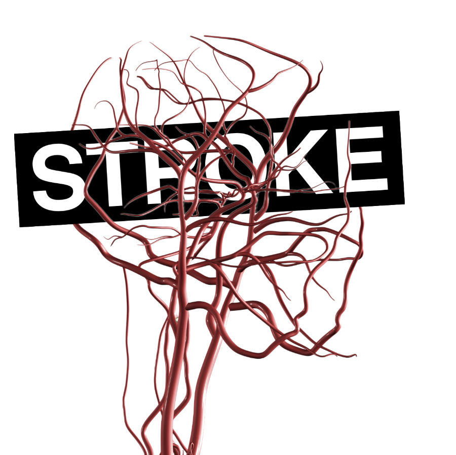 Ultra-Early Thrombolysis Proves Beneficial for Stroke Treatment - The