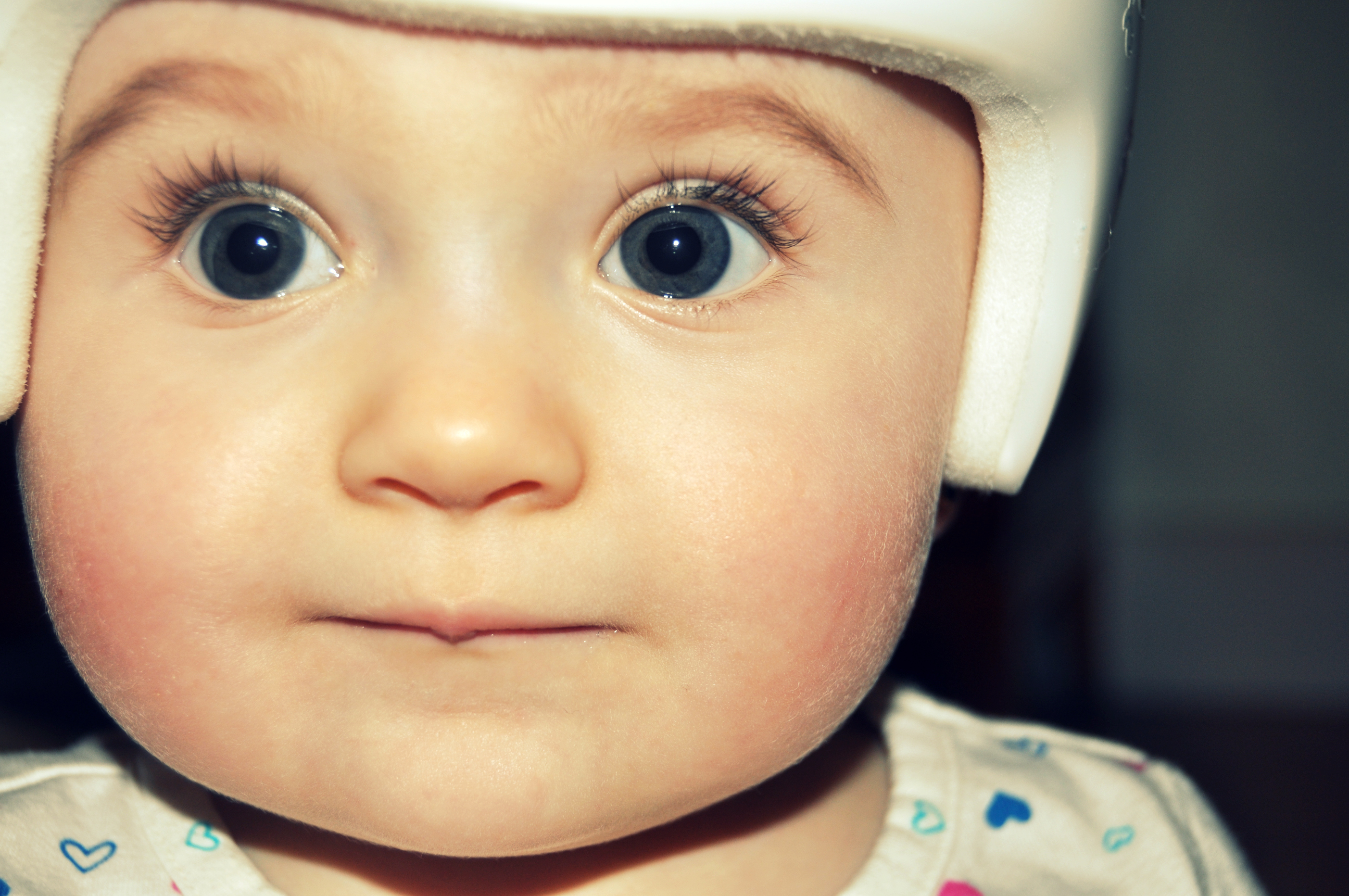 Helmets Show Little Promise in Preventing Head Deformities in Infants