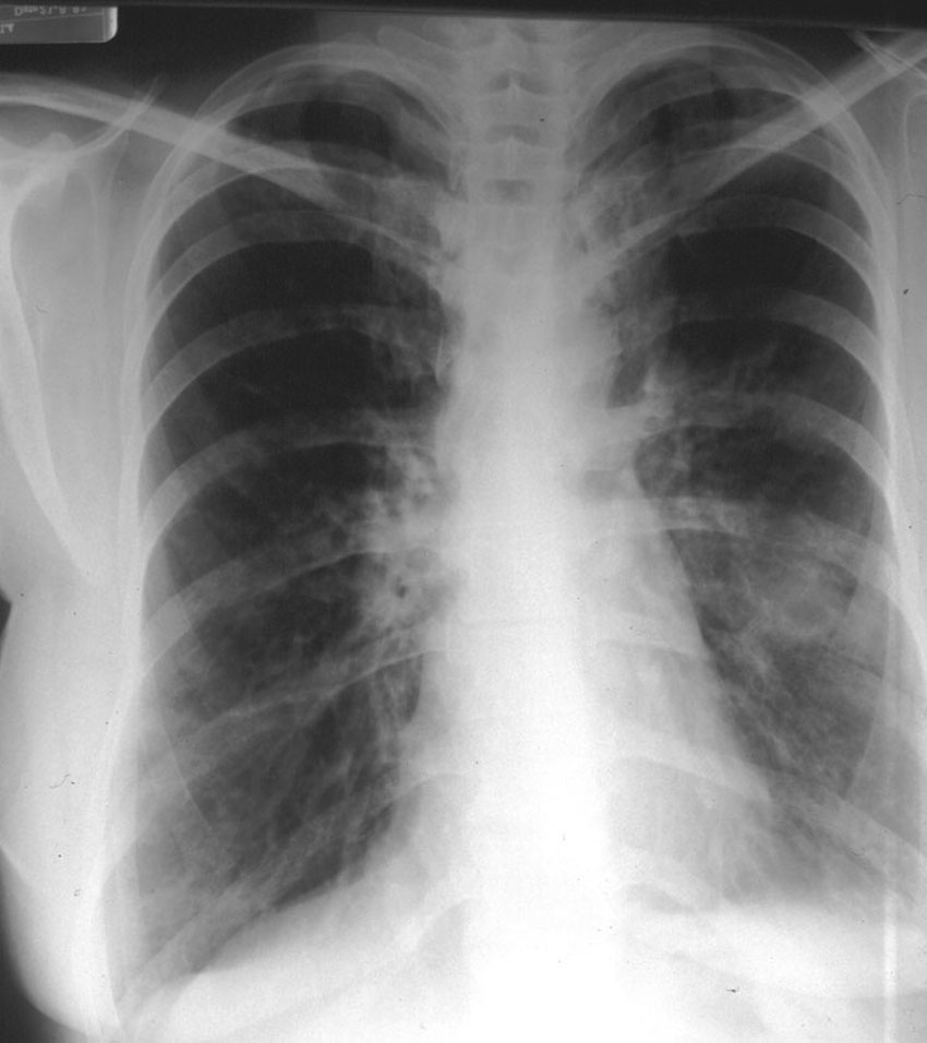 A Good Dfence Against Asthma The Doctor's Channel