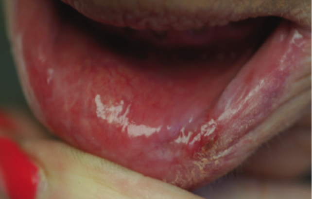 sore lips inside mouth - MedHelp