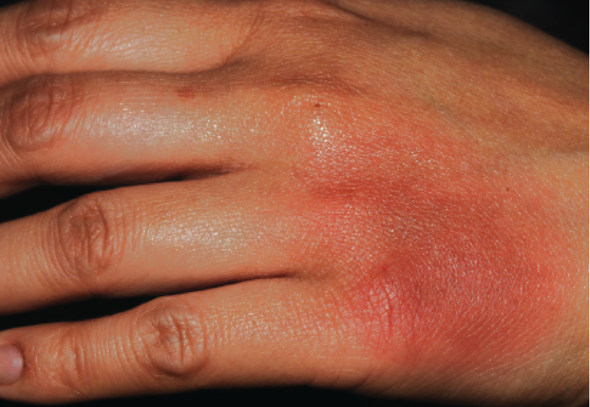 Winter Rash On Hands Hand Rashes Albuquerque NM Dermatologist 