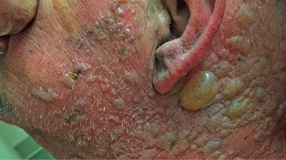Esophageal Cancer Rash