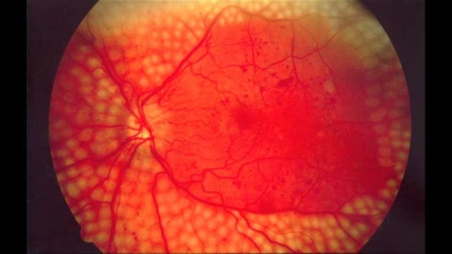 Diabetic Retinopathy: Cause and Treatment Thumbnail