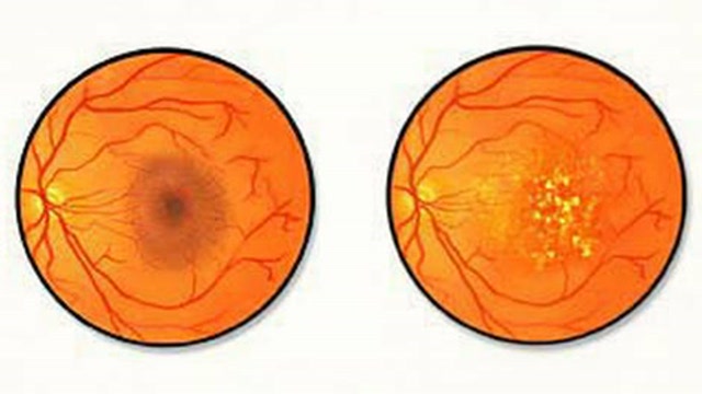 Treatment for Macular Degeneration Thumbnail