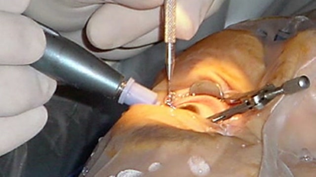 Cataract Surgery Thumbnail