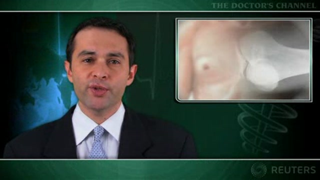 Midlife bone fracture a risk factor for male breast cancer Thumbnail