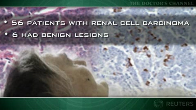 Renal tumor surgery safe in selected elderly patients Thumbnail