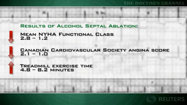 Benefits of septal ablation for obstructive cardiomyopathy maintained long-term Thumbnail