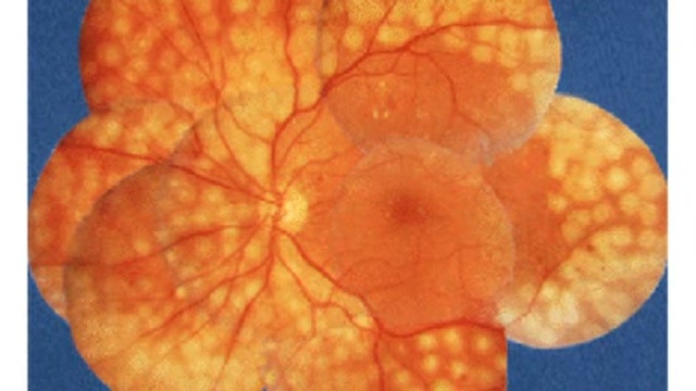 Focal Laser Treatment for Macular Edema Thumbnail
