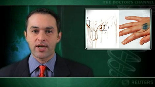 Intralymphatic allergen immunotherapy fast, safe, effective Thumbnail