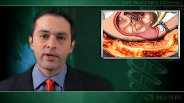 Cesarean section and appendectomy can be safely combined Thumbnail