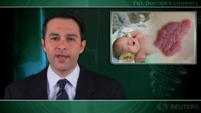 Low birth weight linked to risk of infantile hemangioma Thumbnail