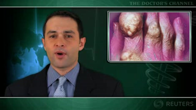 Gout may have protective effect against Parkinson’s disease Thumbnail