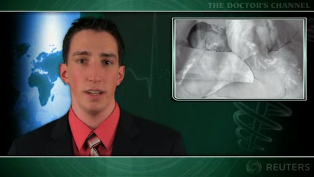 Lack of sleep in early middle age tied to coronary artery calcification Thumbnail