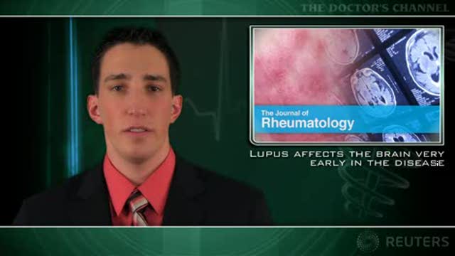 Lupus affects the brain very early in the disease Thumbnail