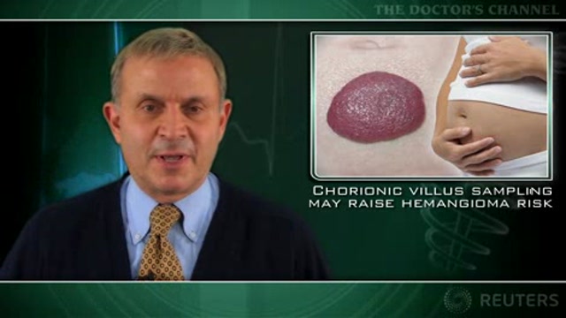Chorionic villus sampling may raise hemangioma risk Thumbnail