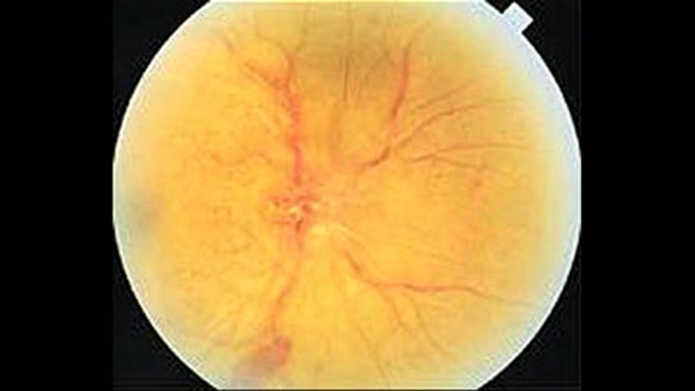 Epidemiology and Treatment of Ischemic Optic Neuropathy Thumbnail