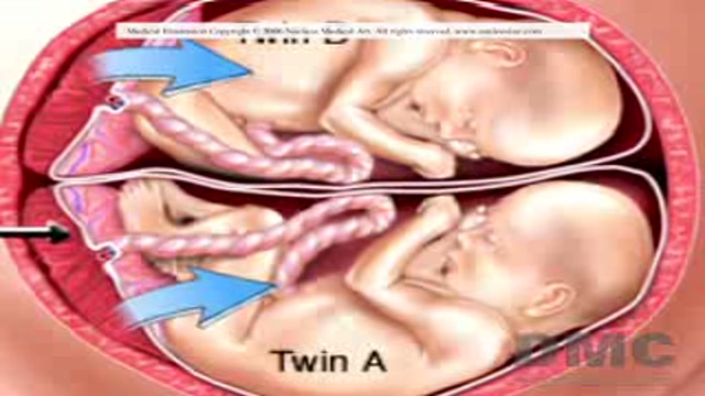 In-Utero Surgery Saves Infant Twins Thumbnail
