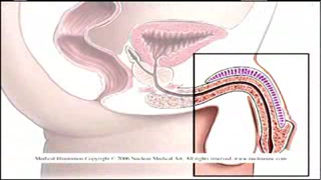Breakthrough in Urinary Surgery Thumbnail