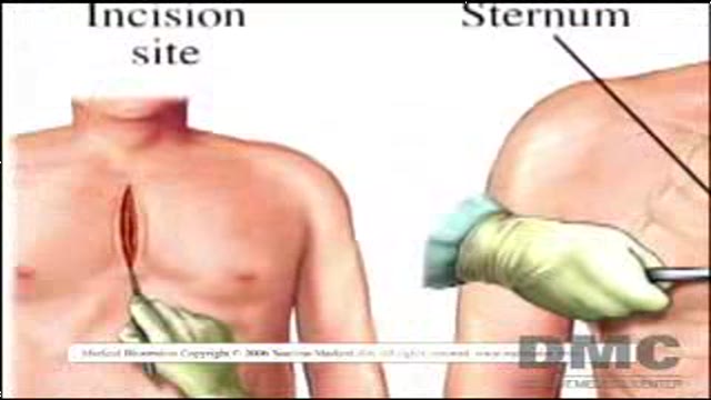 Robotically Assisted Surgery Thumbnail