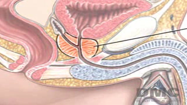 Cell Freezing Treatment for Prostate Cancer Thumbnail
