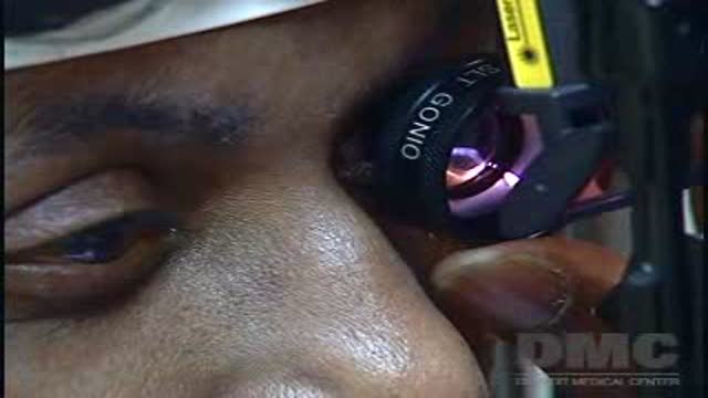 Laser Surgery for Glaucoma Thumbnail