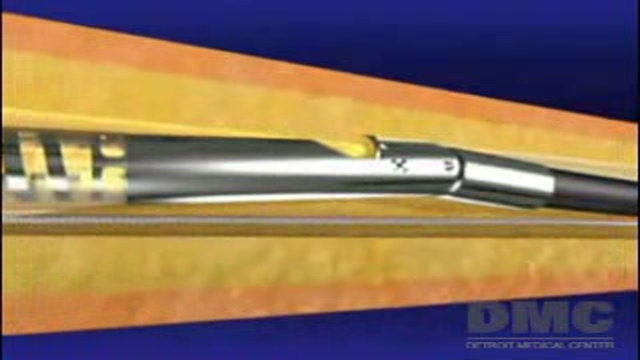 Peripheral Arterial Disease: An Alternative to Amputation Thumbnail