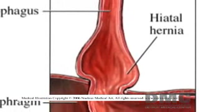Relief from Acid Reflux Thumbnail