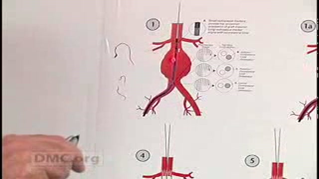 Endovascular Repair for Abdominal Aortic Aneurysm Thumbnail