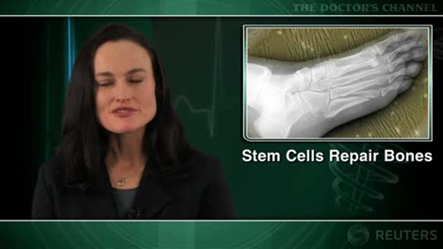 Stem cell allograft helps foot bones heal Thumbnail