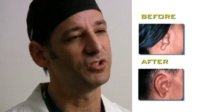 Microtia – New techniques to Repair the External Ear Thumbnail