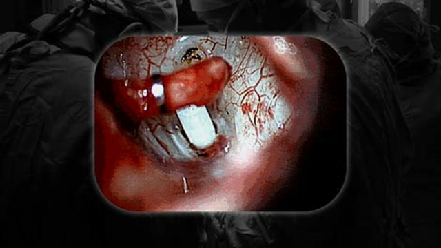 Stapedectomy surgery for hearing loss caused by otosclerosis Thumbnail