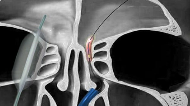 Balloon sinuplasty Thumbnail