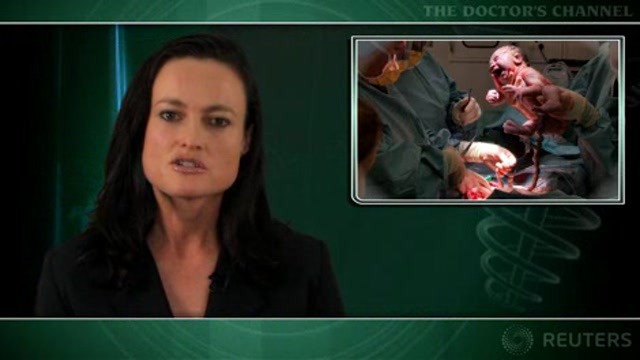 Probiotic use cuts allergy risk in cesarean-delivered children Thumbnail