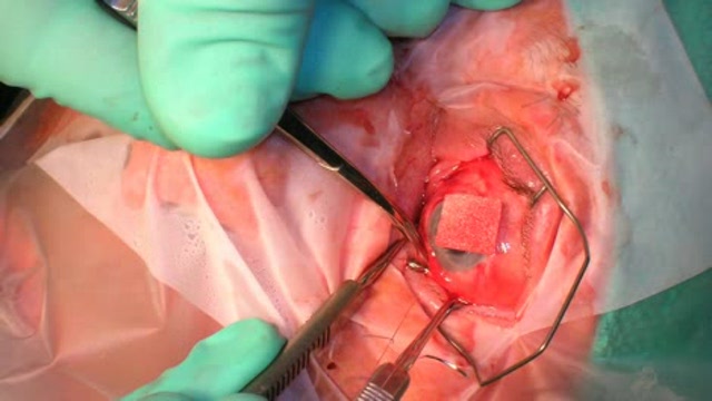 Strabismus Thumbnail