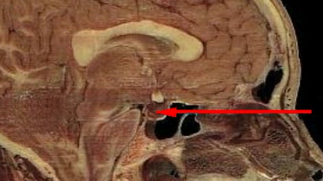 Gamma knife surgery for pituitary adenoma Thumbnail