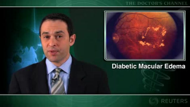 Glitazones may raise risk of diabetic macular edema Thumbnail