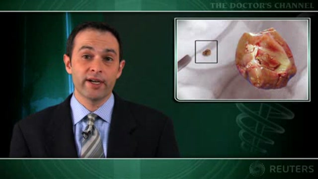 Calcium may help prevent hyperoxaluric kidney stones Thumbnail