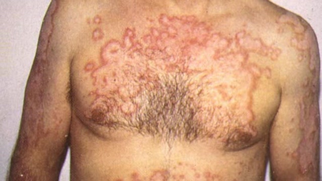 Uveitis Background Thumbnail