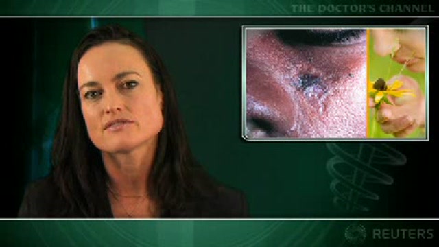 Olfactory sense reduced in lupus patients Thumbnail