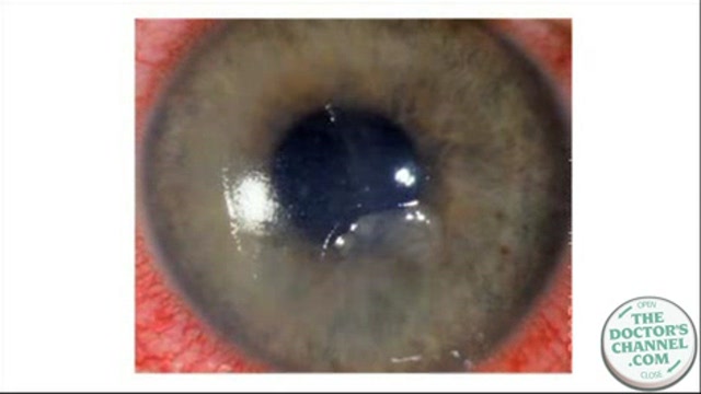 Corneal infections Thumbnail