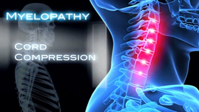 Artificial cervical discs Thumbnail