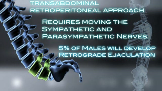 The Artifical Lumbar Disc Thumbnail