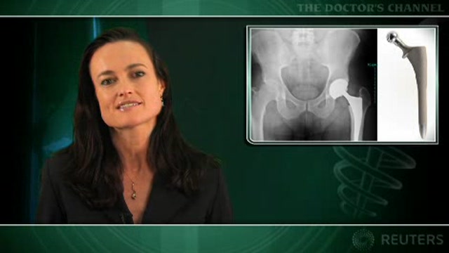 Fixation of cementless acetabular implants stable for at least 20 years Thumbnail